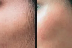 gentle-hair-removal-candela-p1.jpg