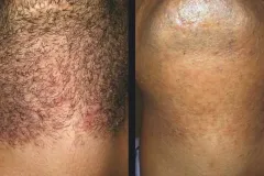 gentle-hair-removal-candela-p3.jpg